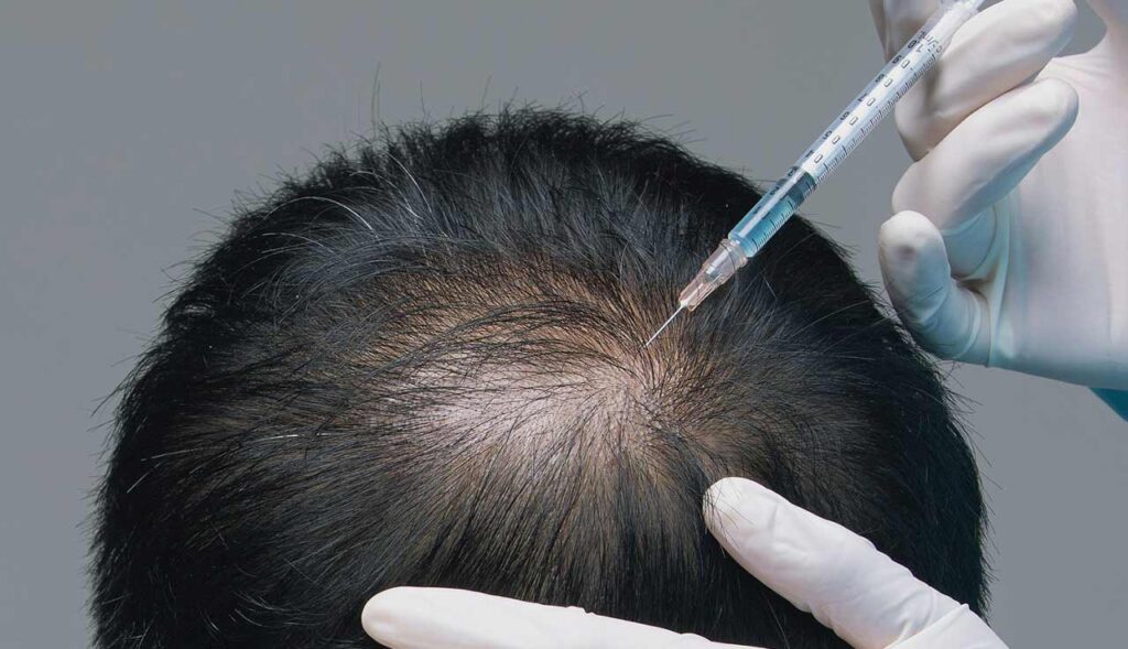 Peptides for Hair Growth and Hair Loss